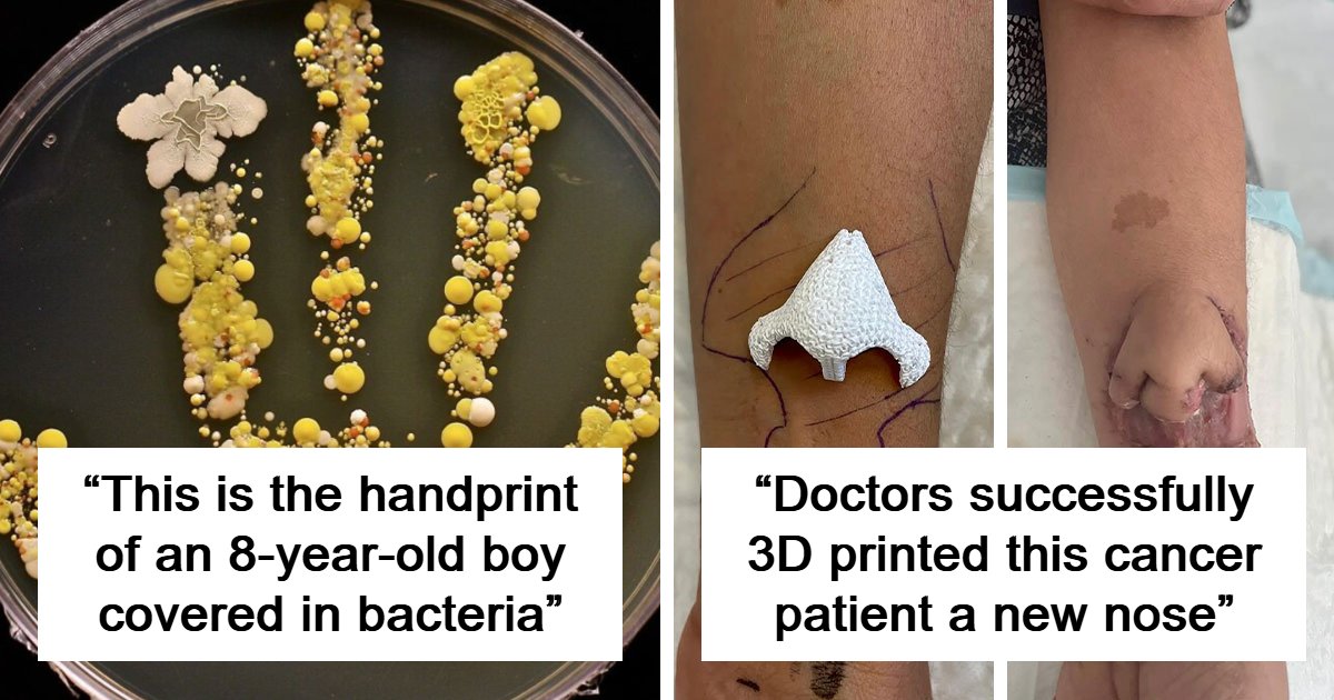 “27 Contact Lenses Lost In Woman’s Eye”: 69 Fascinating And Deeply Disturbing Medical Images You Won’t Be Able To Unsee