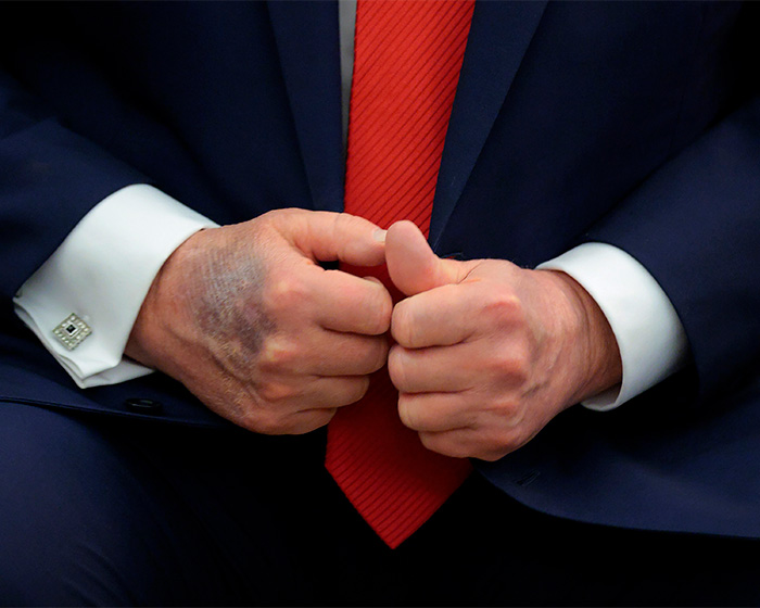 Close-up of hands with visible skin discoloration, highlighting doctors weighing in on Trump's neck rash cause.