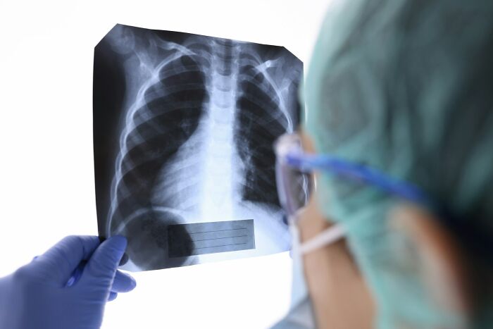 Doctor wearing surgical mask and gloves examining chest X-ray scan related to malfunctioning brain in ER visits.