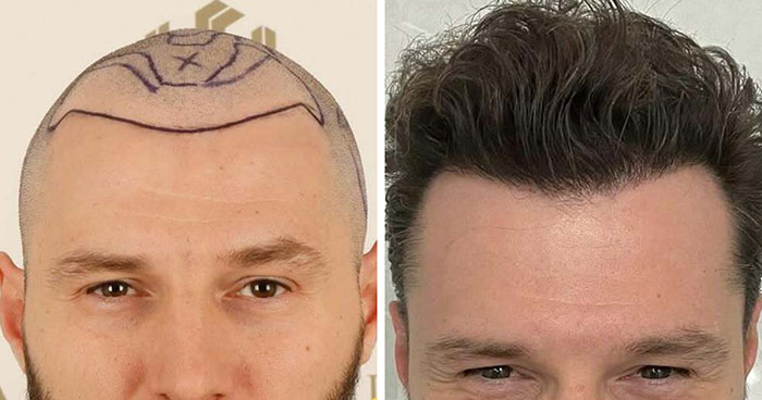 Surgeons Show What A Hair Transplant Can Do With 81 Before And After Pics