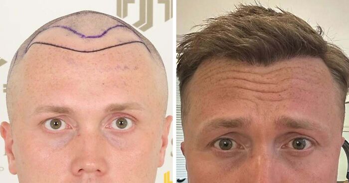 81 Hair Transplant Transformations That Completely Changed These People’s Looks
