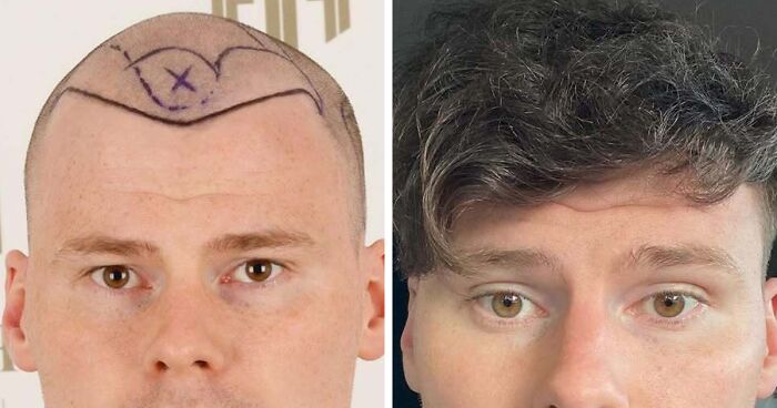 81 Hair Transplant Transformations That Completely Changed These People’s Looks