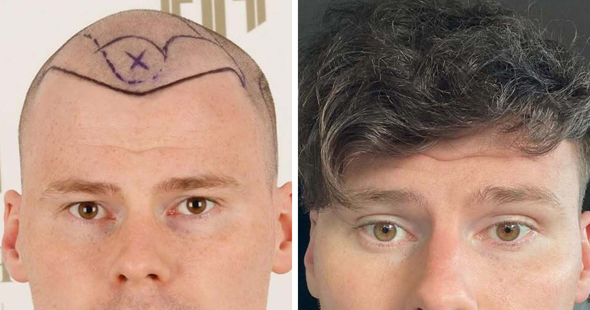 Surgeons Show What A Hair Transplant Can Do With 81 Shocking Before And