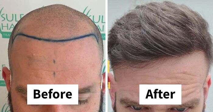 81 Hair Transplant Transformations That Completely Changed These People’s Looks
