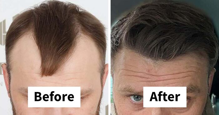 81 Hair Transplant Transformations That Completely Changed These People’s Looks