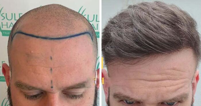 81 Hair Transplant Transformations That Show The Power Of Modern Procedures