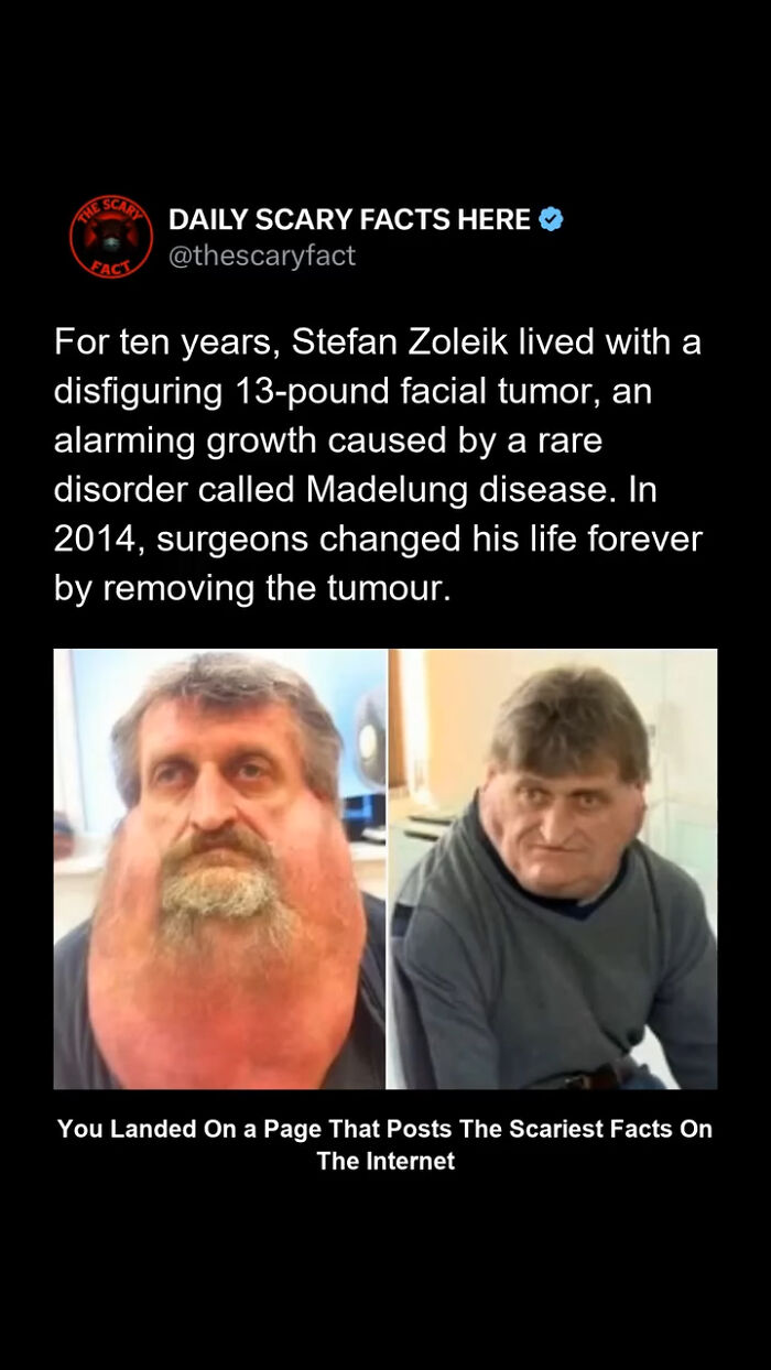 Before and after images of a man with a large facial tumor removed, illustrating a scary fact about Madelung disease.