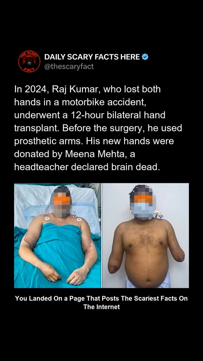Patient after bilateral hand transplant surgery in 2024, illustrating a scary fact about medical miracles and organ donation.