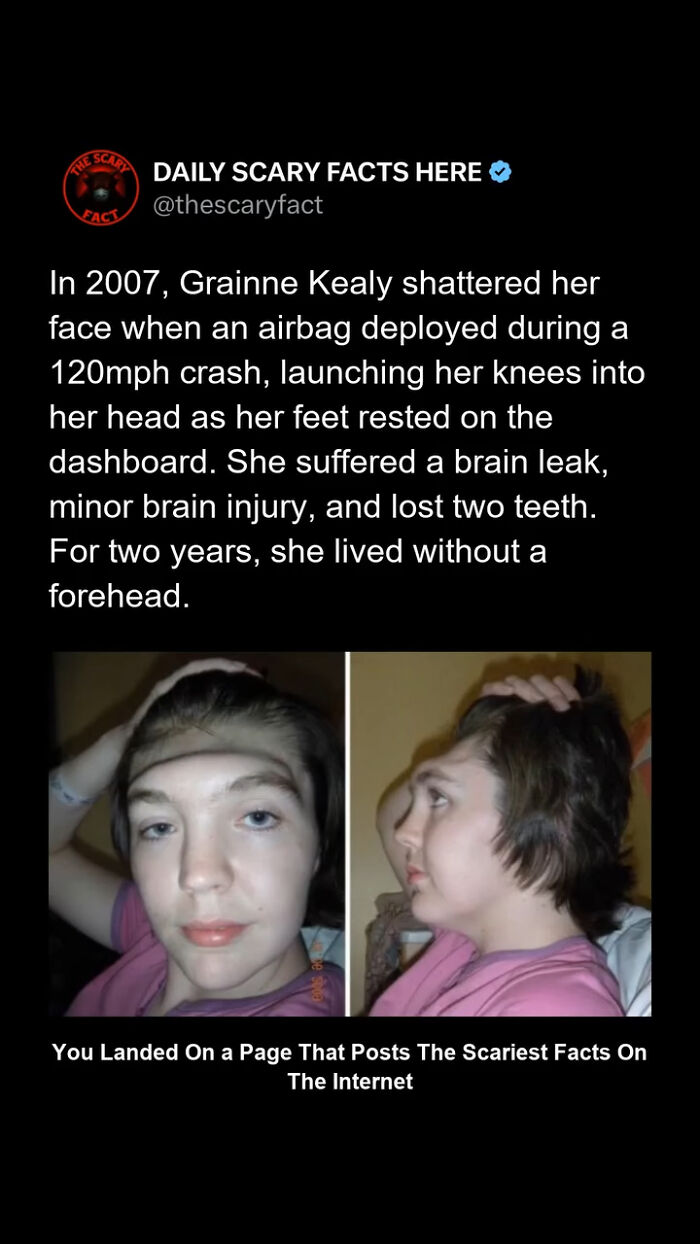 Person showing head injury after airbag crash, illustrating a scary fact about severe brain and facial trauma.