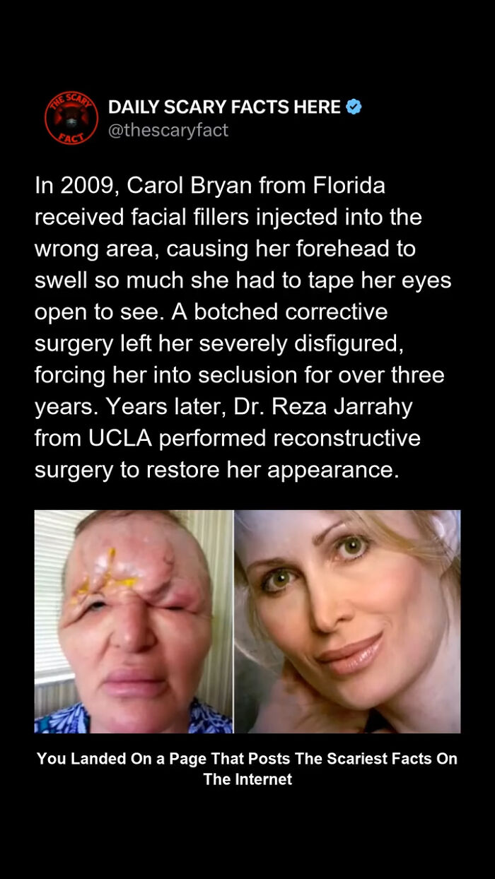 Before and after photos showing severe facial disfigurement and reconstruction surgery, illustrating a scary fact about medical errors.