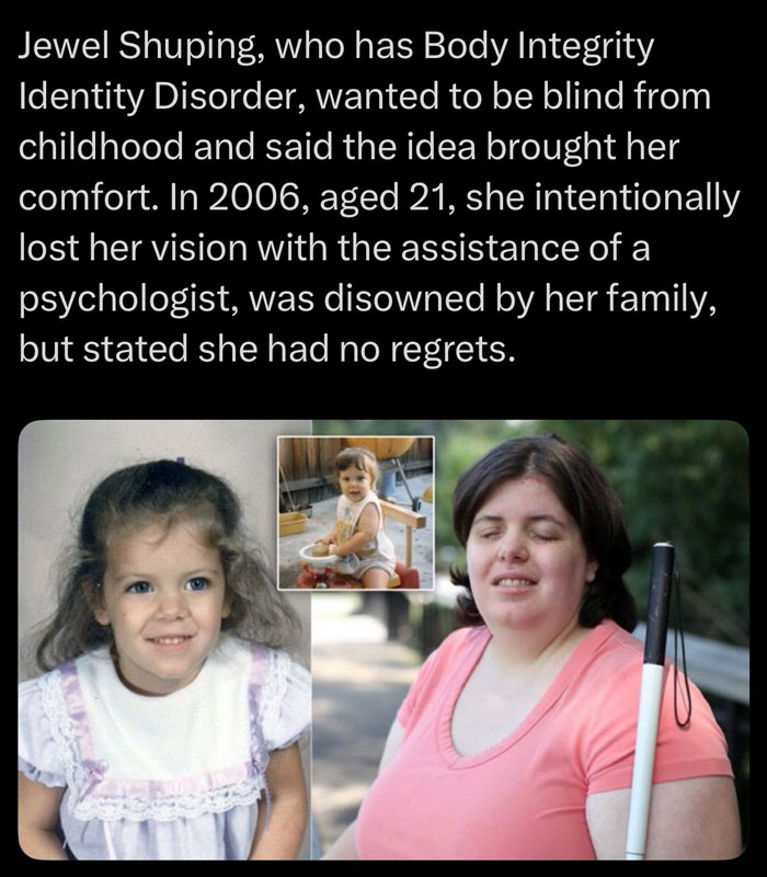 Text about Jewel Shuping with Body Integrity Identity Disorder who chose blindness, accompanied by childhood and adult photos.
