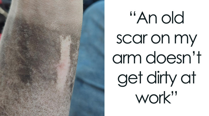People Share 65 Photos Of The Unusual Things That Happened To Their Bodies