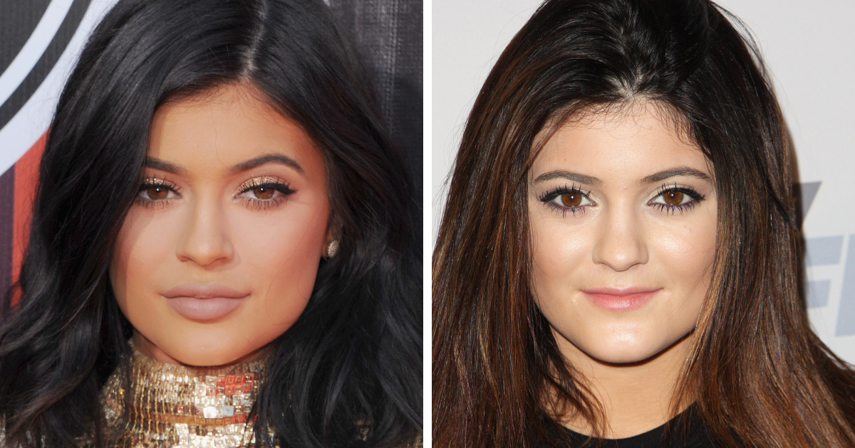 Kylie Jenner Before And After What She Confirmed And What She Denies Kylie Jenner Before And After What She Confirmed And What She Denies
