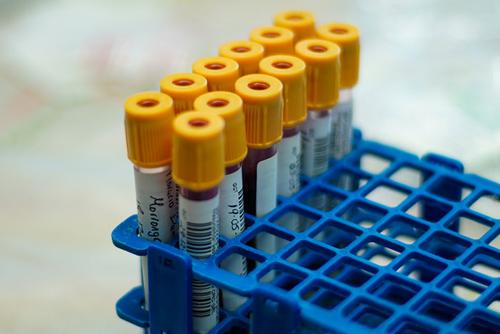 Test tubes with yellow caps in a blue rack, representing DNA lab paternity testing and mixed results.