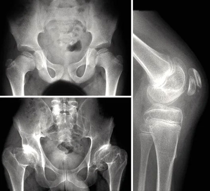 X-ray images of human hips and knee joint showing bone structure related to neurological adulthood development.