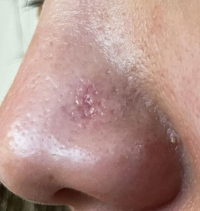 Close-up of a nose with inflamed skin and blemishes illustrating hospital experiences involving skin infections.