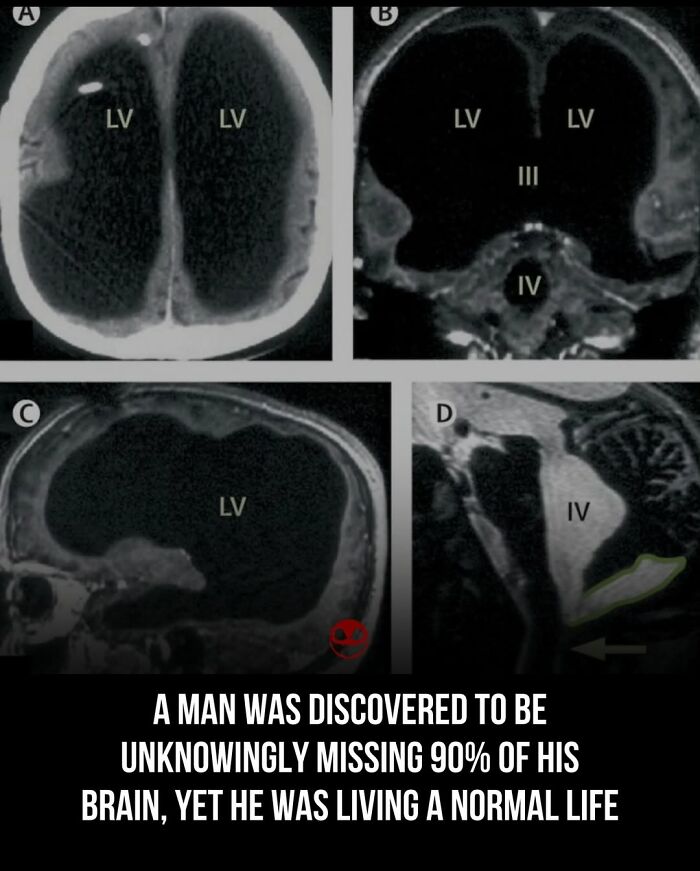 Brain scans showing a man missing 90 percent of his brain, one of the weird and odd facts to give your brain something to think about.