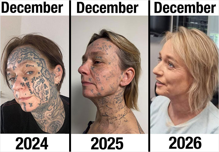 52-year-old woman's tattoo removal transformation over three years after partner forced 250 name tattoos on her face and neck. 52-year-old woman's tattoo removal transformation over three years after partner forced 250 name tattoos on her face and neck.