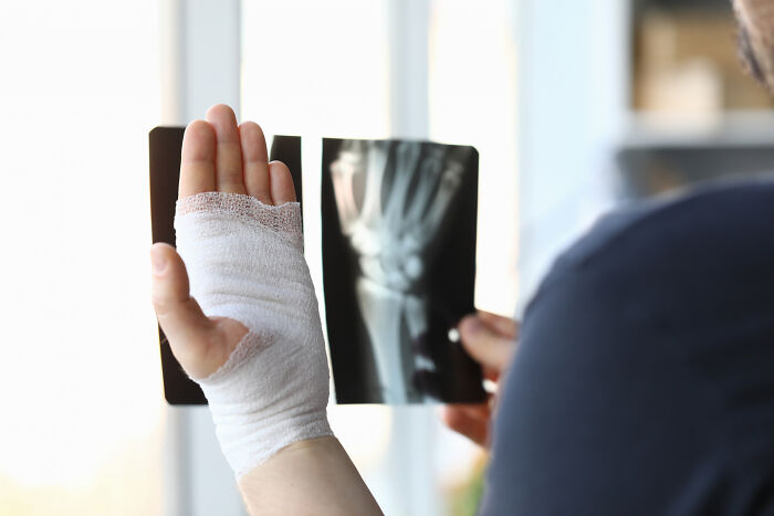 A person with a bandaged hand looks at an X-ray of their wrist, contemplating disturbing sounds from an injury.