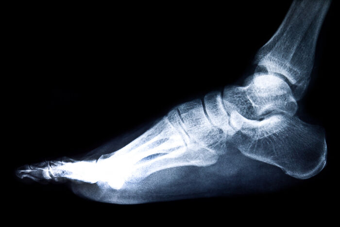 X-ray image of a human foot bone structure illustrating strength and resilience against horrible bullies challenges in life