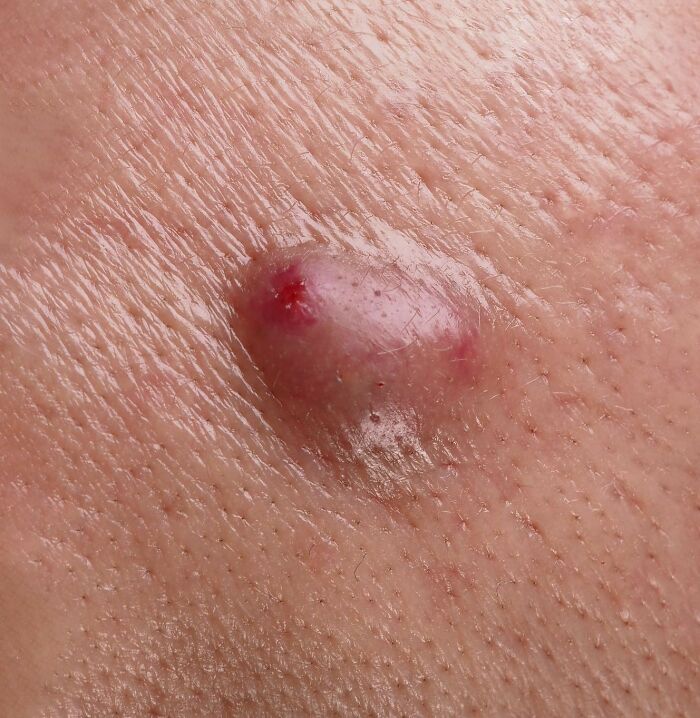 Inflamed skin lesion with redness, a nasty, revolting thing medical workers witness.