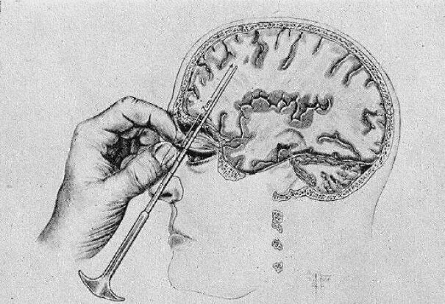 Illustration of an old medical procedure on the brain, highlighting interesting and fun facts about brain history.