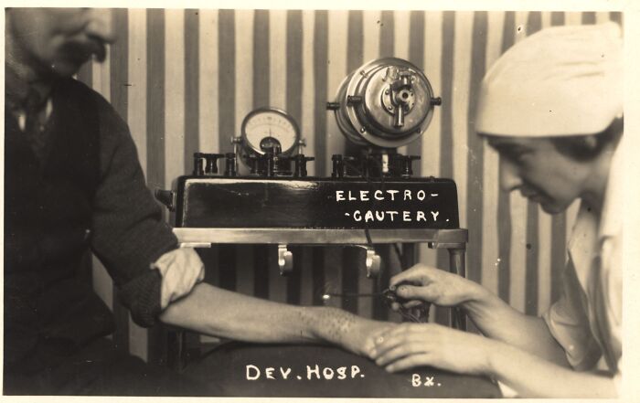 Vintage electro-cautery medical device being used on a patient arm, showcasing early medical devices from the past.