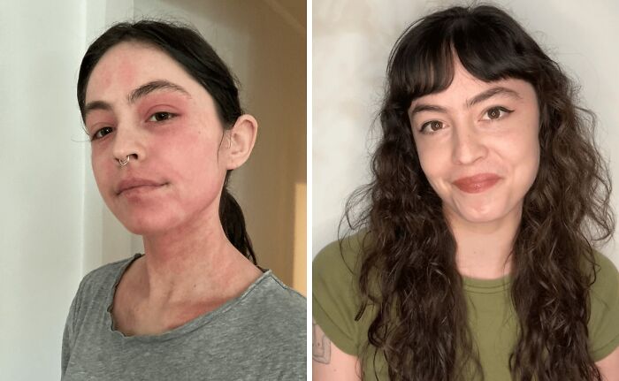 Before and after extreme glow-up of a woman showing dramatic skin transformation and enhanced confidence in two side-by-side photos.