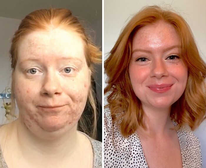Before and after extreme glow-up transformation of a red-haired woman with clearer skin and styled hair smiling.