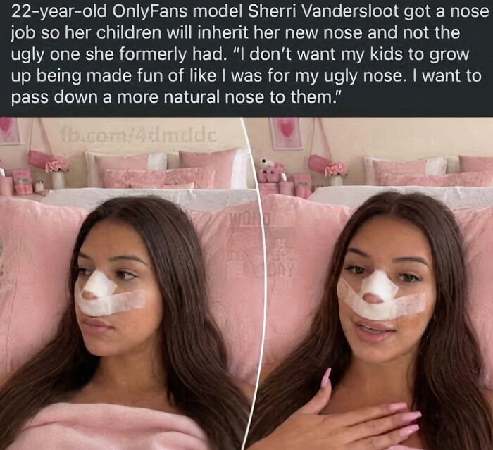 22-year-old OnlyFans model shares nose job story to prevent children inheriting her old nose in a depressing time.
