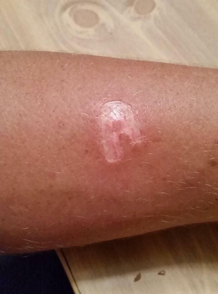 Close-up of a skin scar showing true colors on an arm, illustrating moments people saw the true colors of their friends.