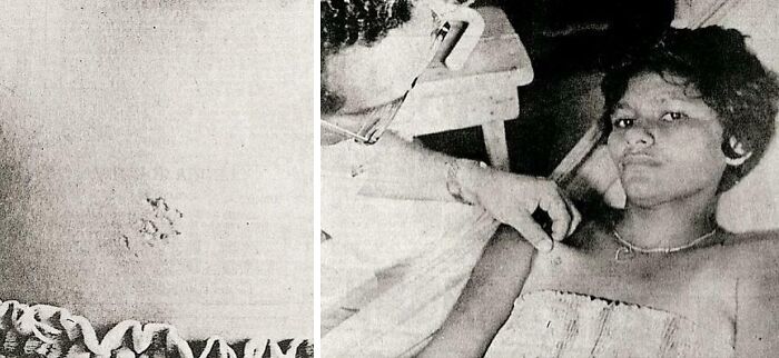 Black and white image of a person lying down showing a mysterious scar, related to unexplained events and urban myths.