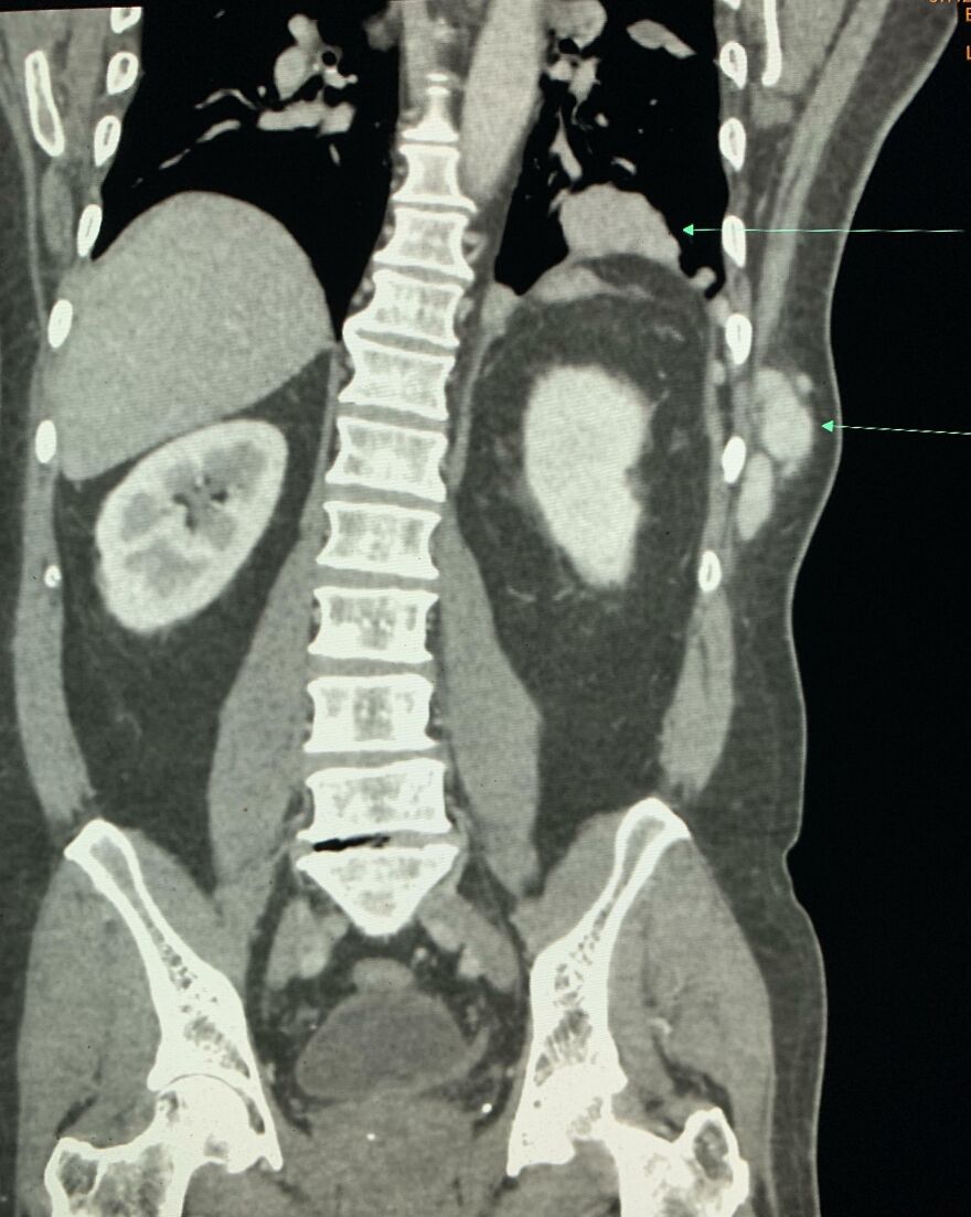 Coronal CT scan of human torso showing spine, kidney, and a large unusual abdominal mass. Highlights human body quirks.