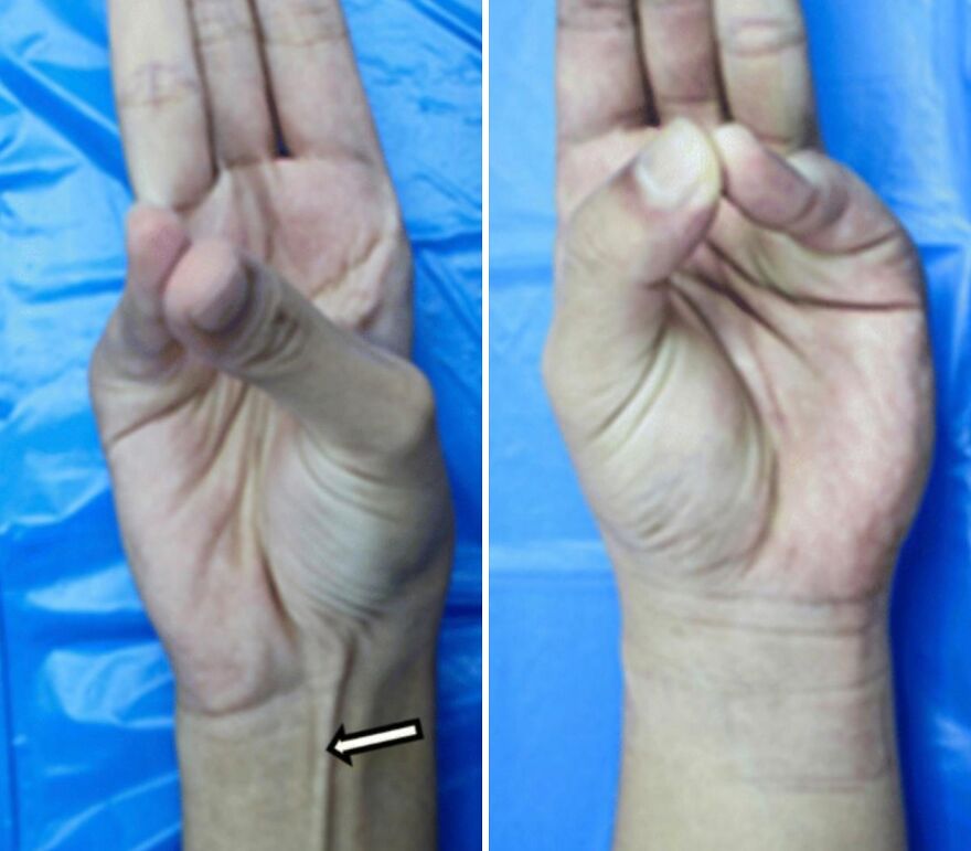 Two wrists comparing a prominent palmaris longus tendon (arrow) to one without, illustrating a common human body quirk.