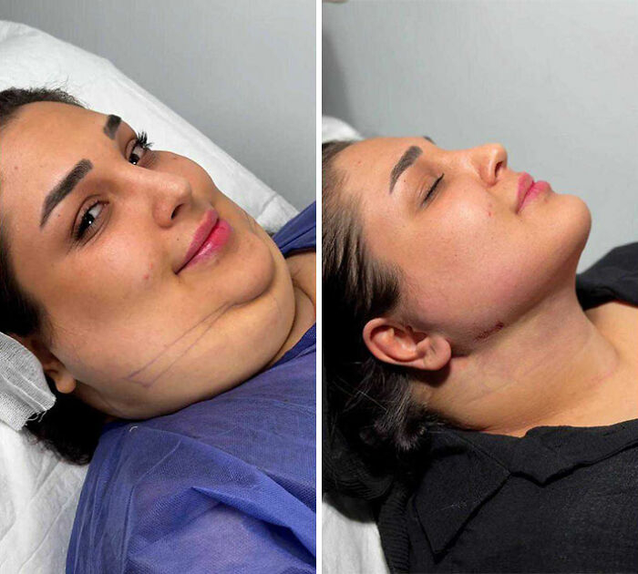 These Viral Face Transformations Look Like Something Is “Snapping” Into Place — And People Are Obsessed (21 Pics)- Interview