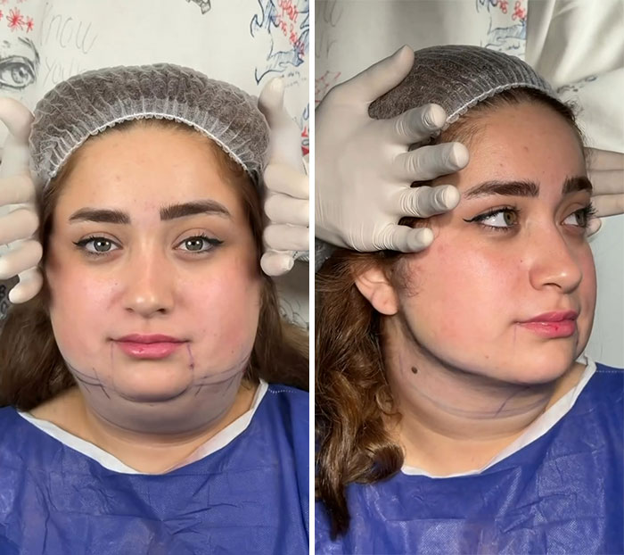 These Viral Face Transformations Look Like Something Is “Snapping” Into Place — And People Are Obsessed (21 Pics)- Interview