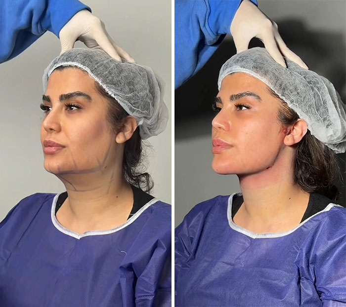 These Viral Face Transformations Look Like Something Is “Snapping” Into Place — And People Are Obsessed (21 Pics)- Interview