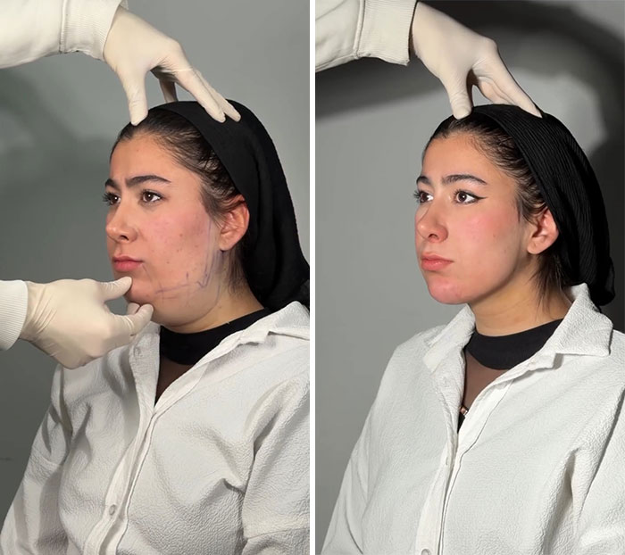These Viral Face Transformations Look Like Something Is “Snapping” Into Place — And People Are Obsessed (21 Pics)- Interview