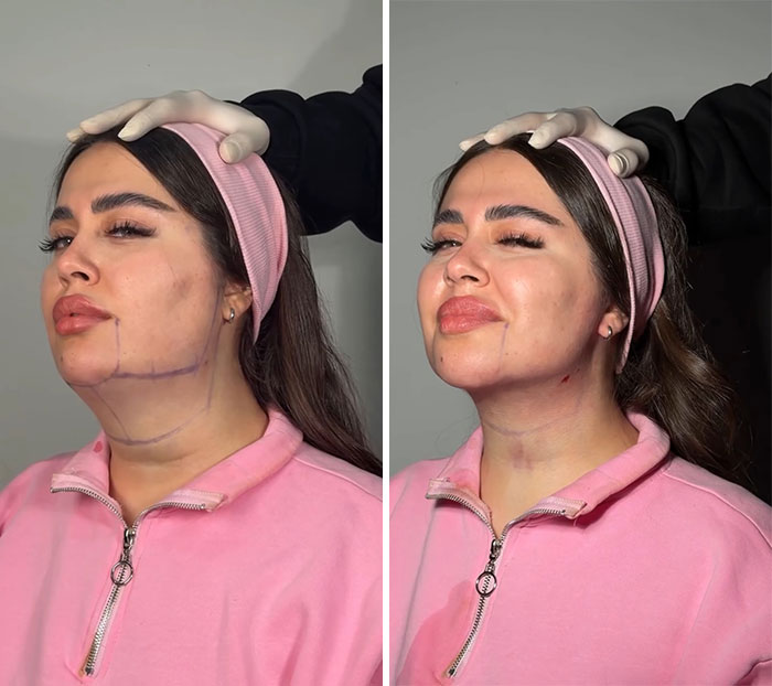 These Viral Face Transformations Look Like Something Is “Snapping” Into Place — And People Are Obsessed (21 Pics)- Interview