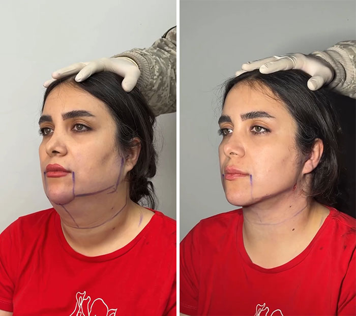 These Viral Face Transformations Look Like Something Is “Snapping” Into Place — And People Are Obsessed (21 Pics)- Interview