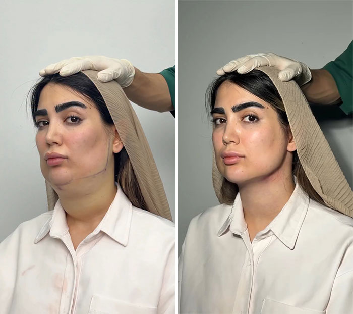 These Viral Face Transformations Look Like Something Is “Snapping” Into Place — And People Are Obsessed (21 Pics)- Interview