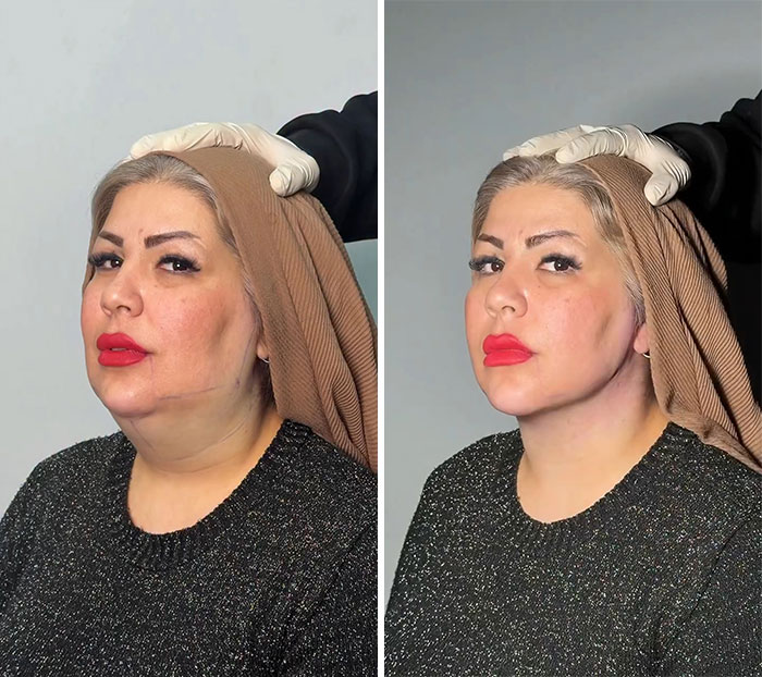 These Viral Face Transformations Look Like Something Is “Snapping” Into Place — And People Are Obsessed (21 Pics)- Interview