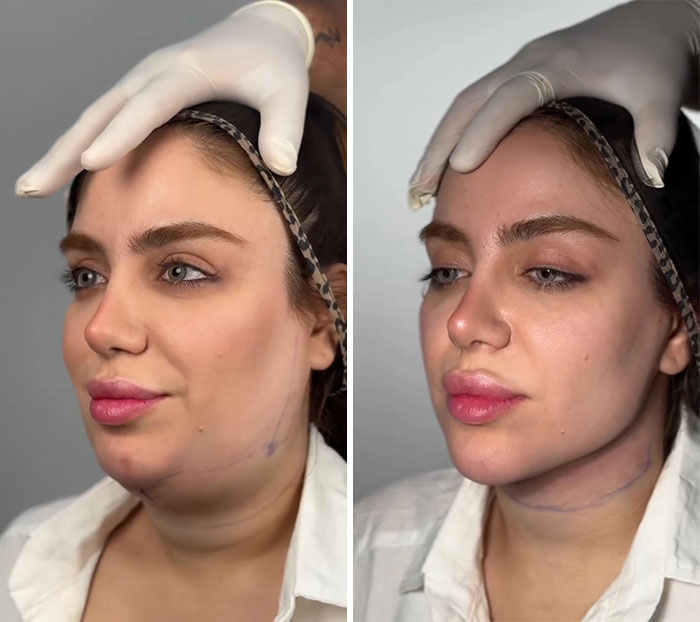 These Viral Face Transformations Look Like Something Is “Snapping” Into Place — And People Are Obsessed (21 Pics)- Interview