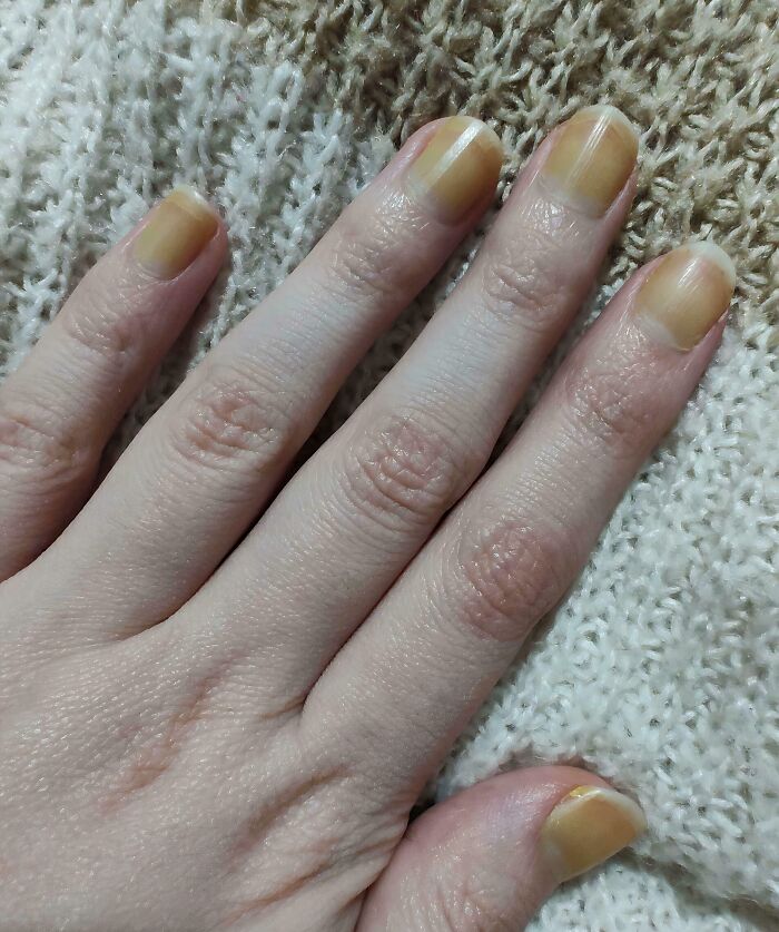 A hand with discolored, yellowing nails, showing a beauty disaster in a salon.