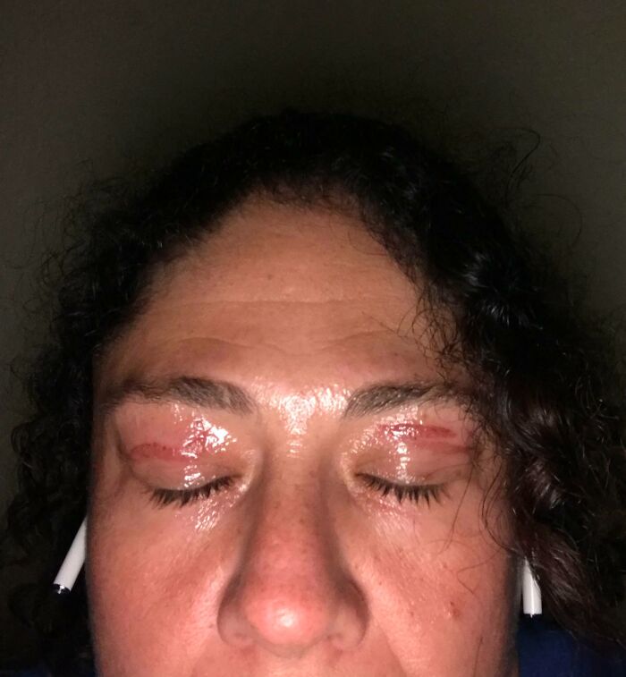 Close-up of a person with closed eyes, displaying red, irritated skin and cuts on both eyelids, a clear beauty disaster.