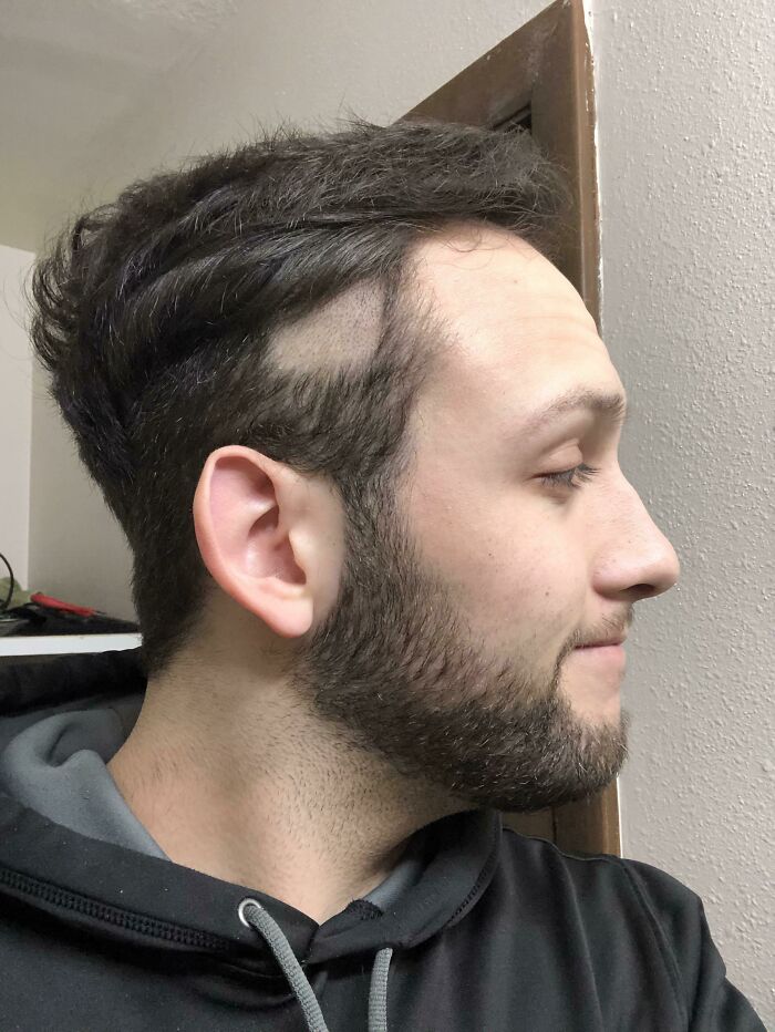 A man with dark hair and a beard, showing a bad haircut with a noticeably shaved patch. A beauty disaster.