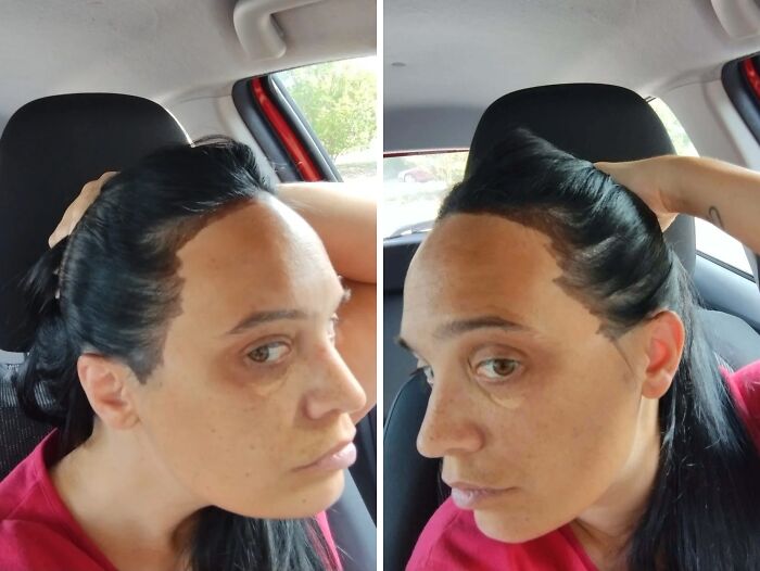 A woman with dark hair pulling it back to reveal an uneven and stained hairline, a common beauty disaster.