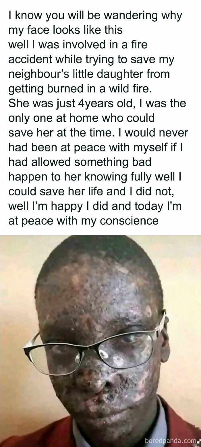 Man with burn scars and glasses sharing a heartfelt story of saving a neighbor's daughter in an incredibly wholesome story.