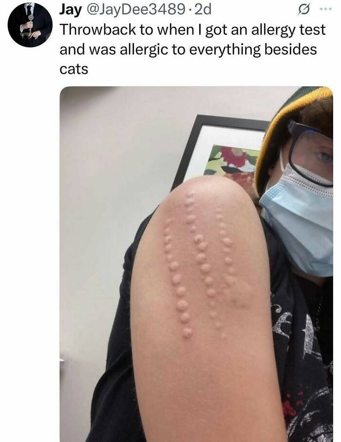 Person showing arm with raised allergy test bumps, a wild meme example from unhinged and wild memes collection
