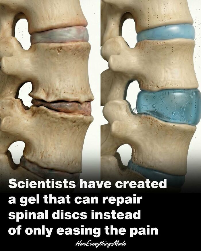 Spinal disc repair with innovative gel demonstrates how everything is made through scientific and medical advancements.